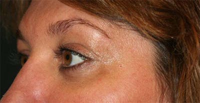 Upper Blepharoplasty Before & After Gallery - Patient 121417476 - Image 2