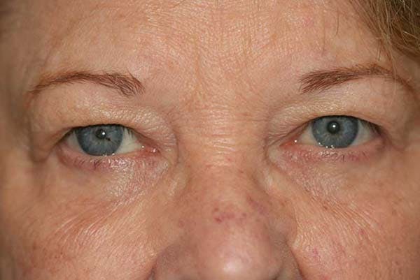 Upper Blepharoplasty Before & After Gallery - Patient 121417477 - Image 1
