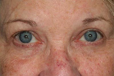 Upper Blepharoplasty Before & After Gallery - Patient 121417477 - Image 2