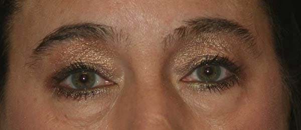 Upper & Lower Blepharoplasty Before & After Gallery - Patient 121417482 - Image 1