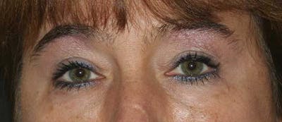 Upper & Lower Blepharoplasty Before & After Gallery - Patient 121417482 - Image 2