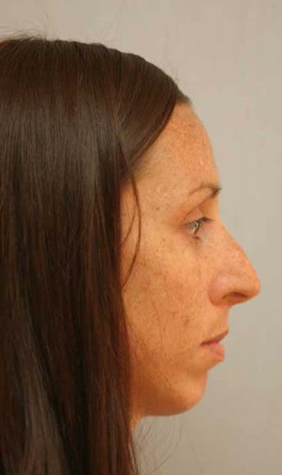 Rhinoplasty Before & After Gallery - Patient 121417492 - Image 1