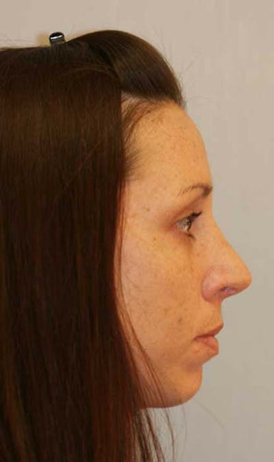 Rhinoplasty Before & After Gallery - Patient 121417492 - Image 2
