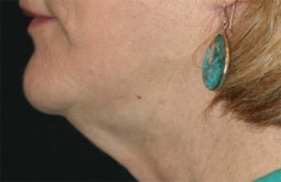 Kybella Before & After Gallery - Patient 121417499 - Image 1