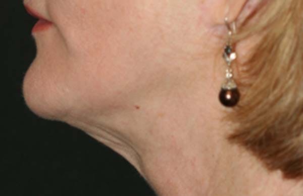 Kybella Before & After Gallery - Patient 121417499 - Image 2