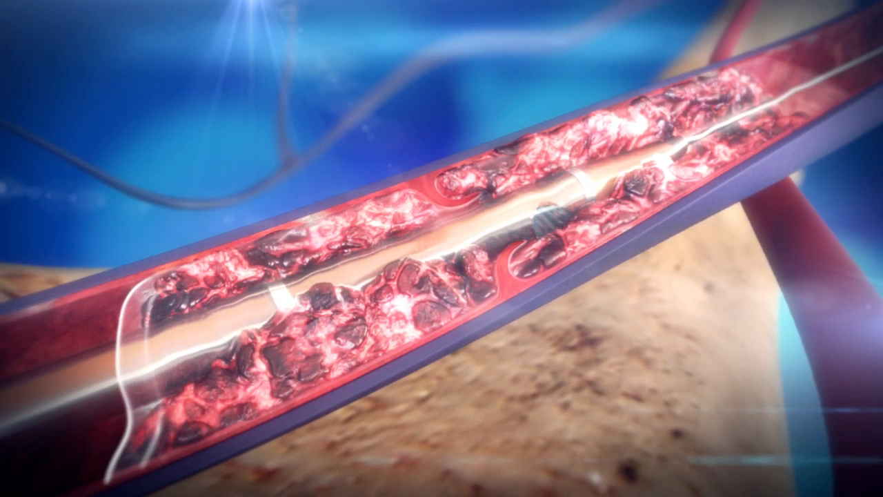 Thrombectomy