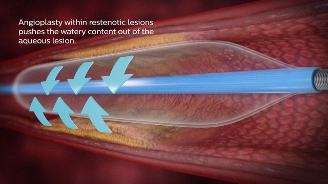 Infographic on Vascular Treatment