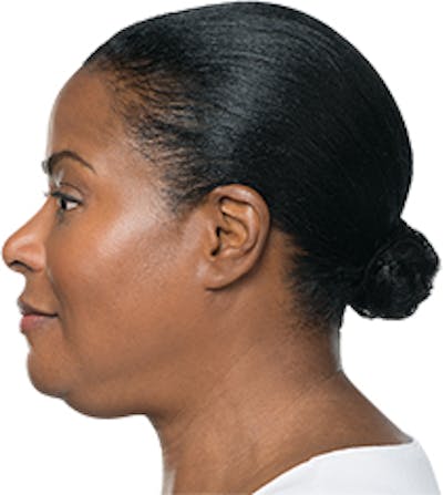 Kybella Before & After Gallery - Patient 32588813 - Image 1