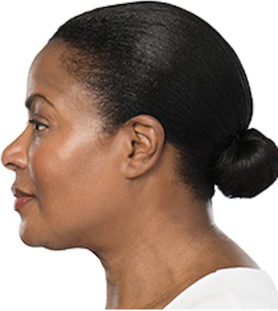 Kybella Before & After Gallery - Patient 32588813 - Image 2