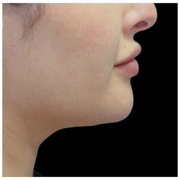 Coolsculpting Before & After Gallery - Patient 24400665 - Image 2