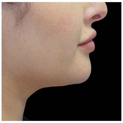 Coolsculpting Before & After Gallery - Patient 24400665 - Image 2