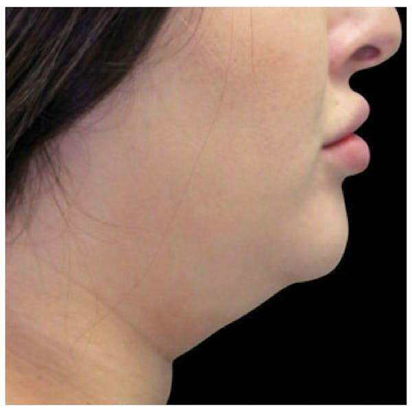 Coolsculpting Before & After Gallery - Patient 24400665 - Image 1