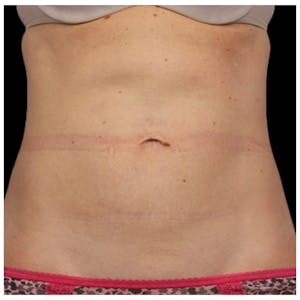 Coolsculpting