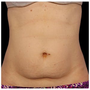 Coolsculpting