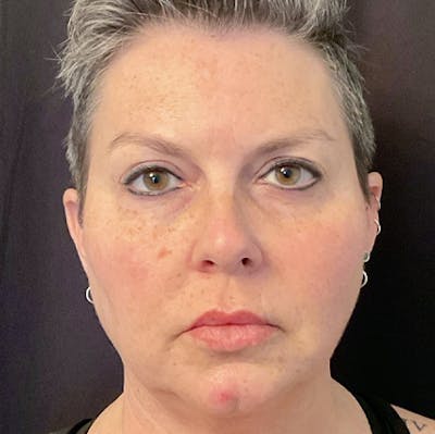 Juvederm Gallery Before & After Gallery - Patient 31283112 - Image 1