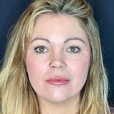 Juvederm Gallery Before & After Gallery - Patient 31283113 - Image 2