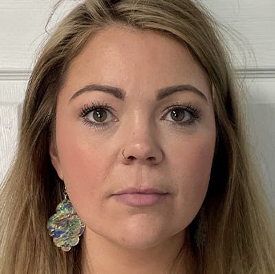 Juvederm Gallery Before & After Gallery - Patient 31283113 - Image 1