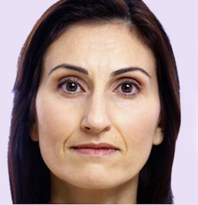 Juvederm Gallery Before & After Gallery - Patient 24400695 - Image 1