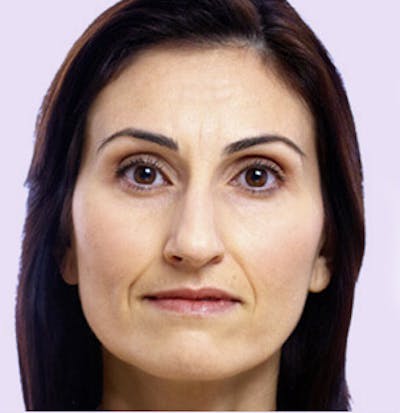Juvederm Before & After Gallery - Patient 24400695 - Image 1