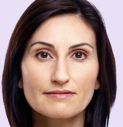 Juvederm Gallery Before & After Gallery - Patient 24400695 - Image 2