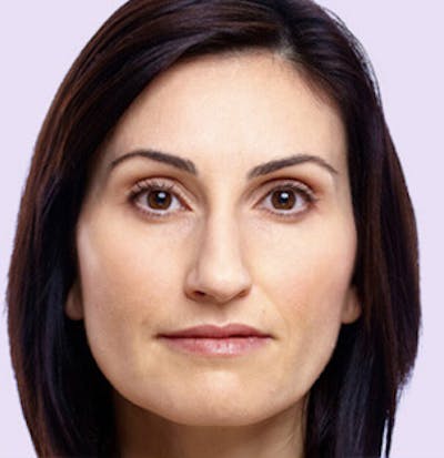 Juvederm Before & After Gallery - Patient 24400695 - Image 2