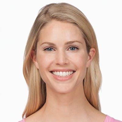Botox Gallery Before & After Gallery - Patient 24400731 - Image 2