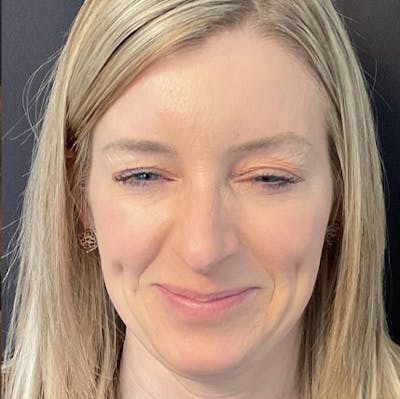 Botox Gallery Before & After Gallery - Patient 32875026 - Image 2