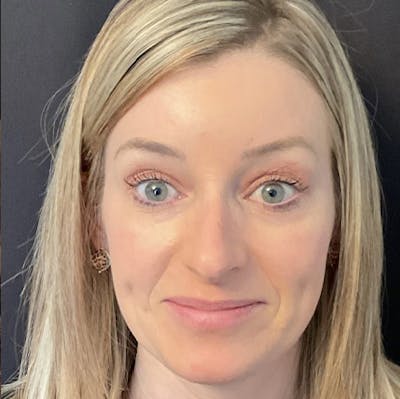 Botox Gallery Before & After Gallery - Patient 32875027 - Image 2