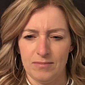 botox
