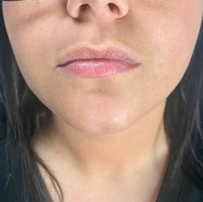 Juvederm Gallery Before & After Gallery - Patient 39995547 - Image 1