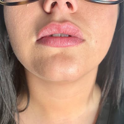 Juvederm Gallery Before & After Gallery - Patient 39995547 - Image 2