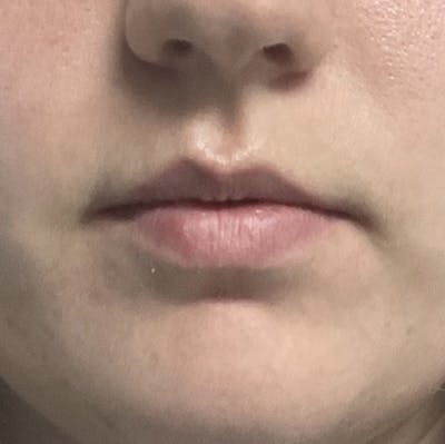 Juvederm Gallery Before & After Gallery - Patient 39995548 - Image 1