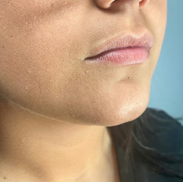 Juvederm Before & After Gallery - Patient 39995547 - Image 3