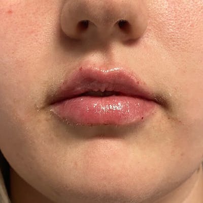 Juvederm Gallery Before & After Gallery - Patient 39995548 - Image 2