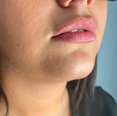 Juvederm Gallery Before & After Gallery - Patient 39995547 - Image 4