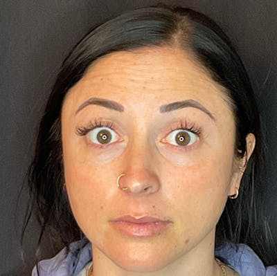 Botox Gallery Before & After Gallery - Patient 39995552 - Image 1