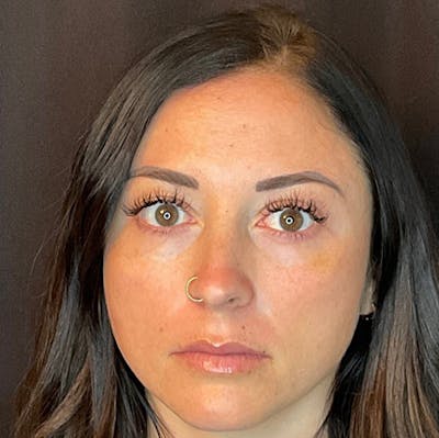 Botox Before & After Gallery - Patient 39995552 - Image 2