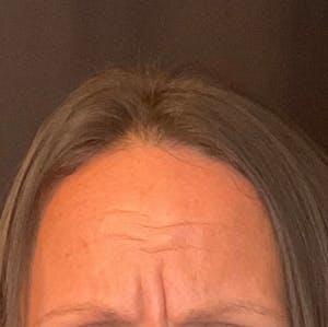 botox