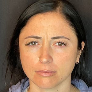 botox