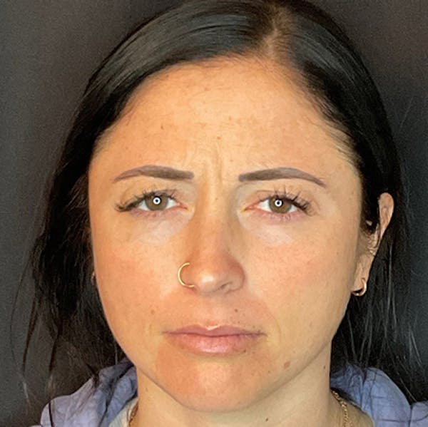 Botox Gallery Before & After Gallery - Patient 39995552 - Image 3
