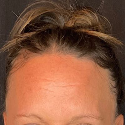 Botox Before & After Gallery - Patient 39995553 - Image 2