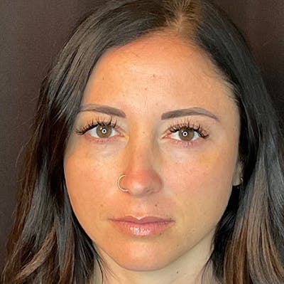 Botox Before & After Gallery - Patient 39995552 - Image 4