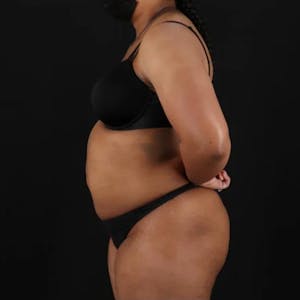 Liposuction
