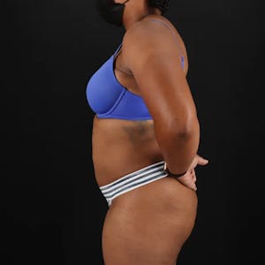 Liposuction