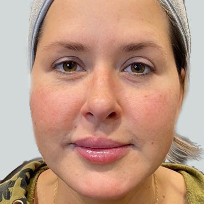 Morpheus8 Gallery Before & After Gallery - Patient 149096603 - Image 1
