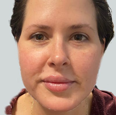 Morpheus8 Gallery Before & After Gallery - Patient 149096603 - Image 2