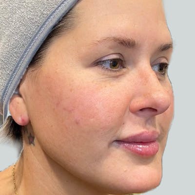 Morpheus8 Gallery Before & After Gallery - Patient 149096563 - Image 1