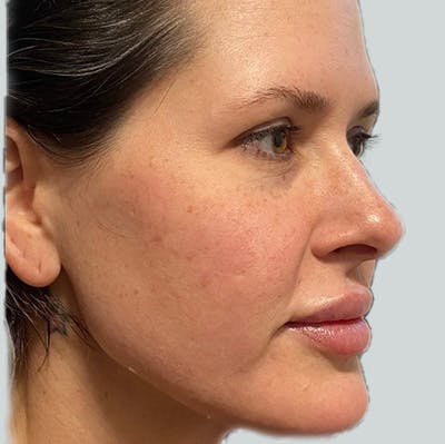 Morpheus8 Gallery Before & After Gallery - Patient 149096563 - Image 2