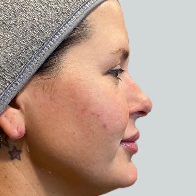 Morpheus8 Gallery Before & After Gallery - Patient 149096604 - Image 1