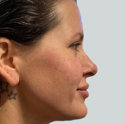 Morpheus8 Gallery Before & After Gallery - Patient 149096604 - Image 2